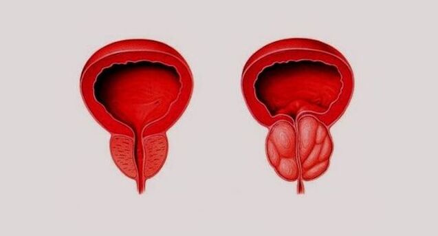 Zdrava prostata (lijevo) i upaljena zbog prostatitisa (desno)