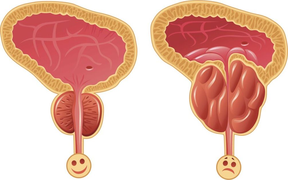 zdrave i bolesne prostate