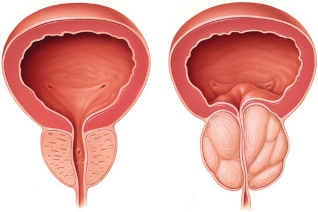 Normalna prostata (lijevo) i sa znakovima upale kod prostatitisa (desno)