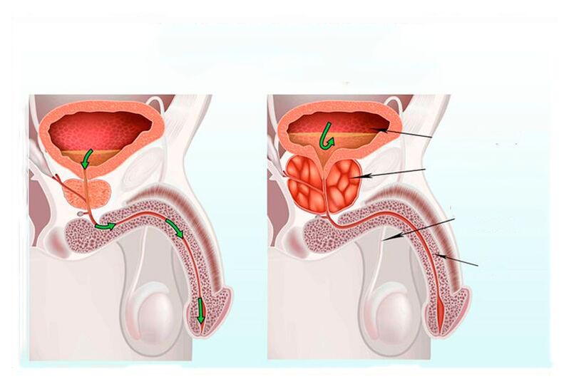 Norma i upala prostate