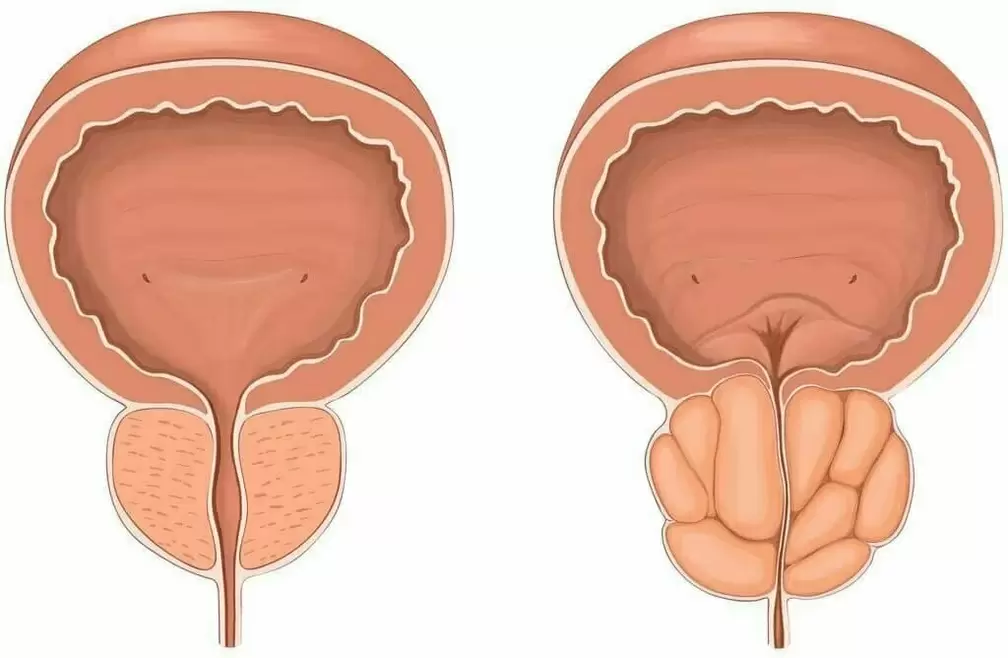 Normalna prostata i bolna prostata
