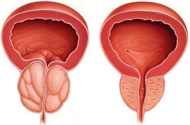zdrava i upaljena prostata s prostatitisom